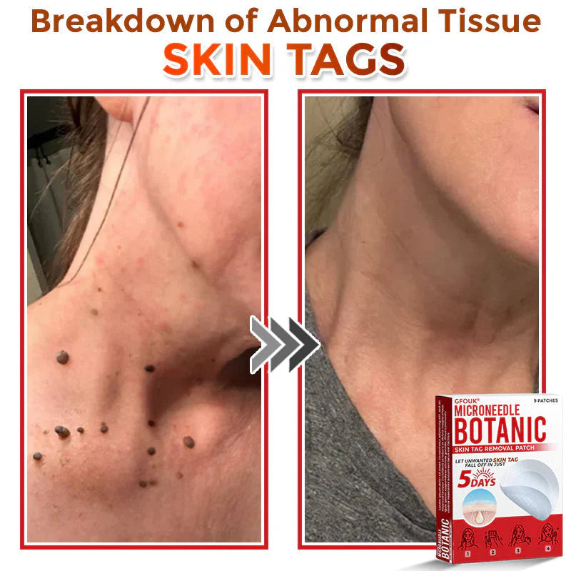 Micro Needle Botanic Patch