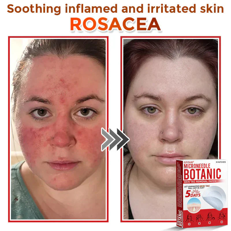 Micro Needle Botanic Patch