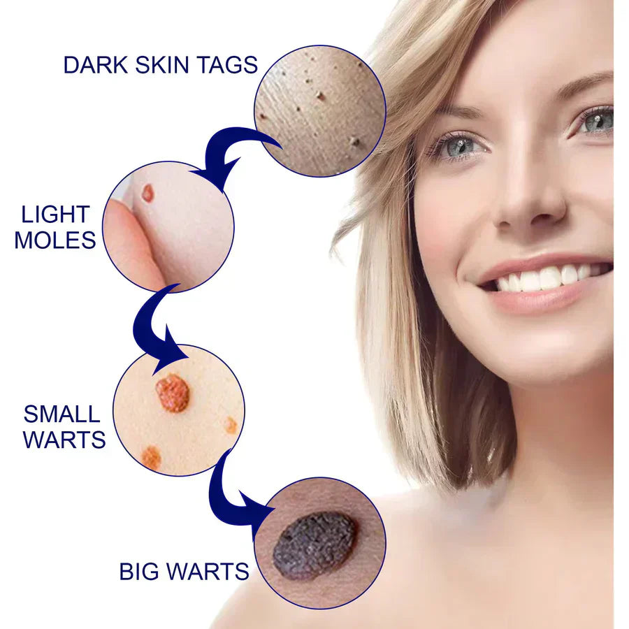 WartAway Herbal Cream