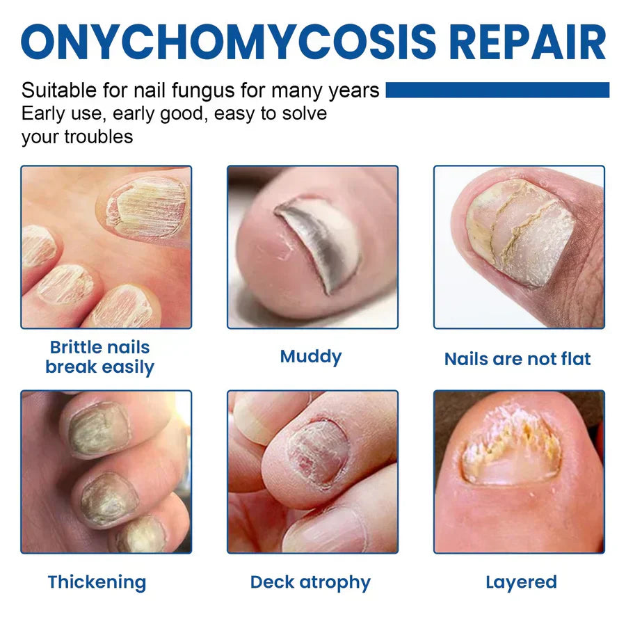#1 Fungal Nail Patches