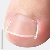 Toenail Correction Strips