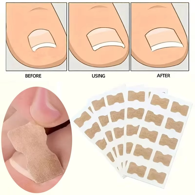 Toenail Correction Strips