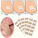 Toenail Correction Strips