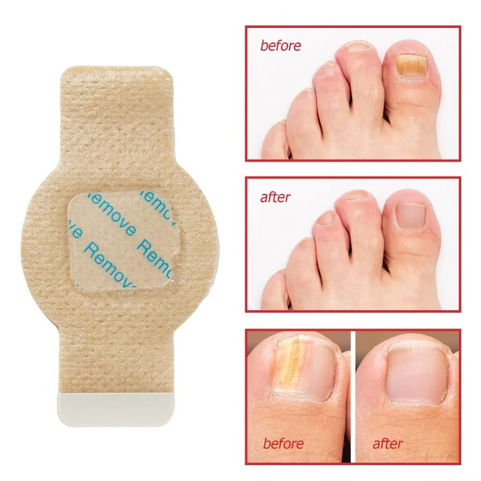 Toenail Correction Strips